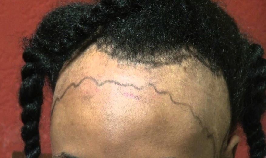 How do you treat or reverse receding hairline in women