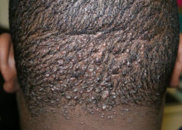 Bumps On The Scalp At The Back Of Head Due To Acne Keloidalis Nuchae 585x419 