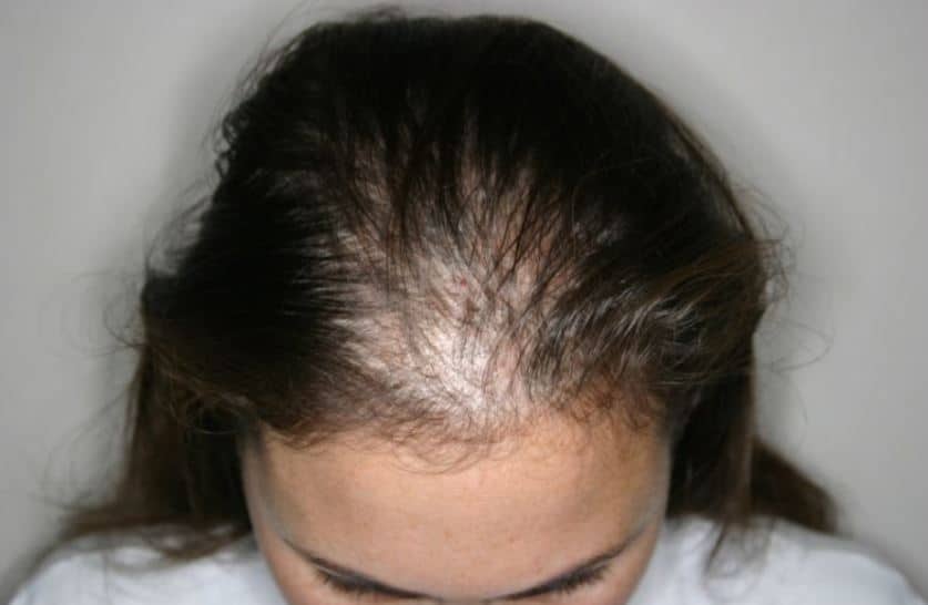 Hair loss and thinning in women