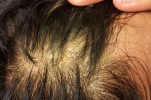 Itchy scalp and hair loss