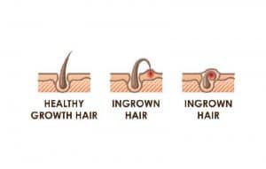Can an Ingrown Hair Cause a Lump?