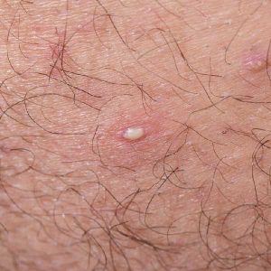 Treating and Preventing Ingrown Hair