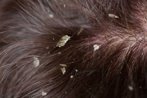 Does Hot Water Cause Dandruff?